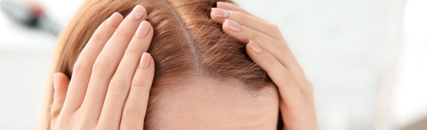 Caída de pelo hormonal