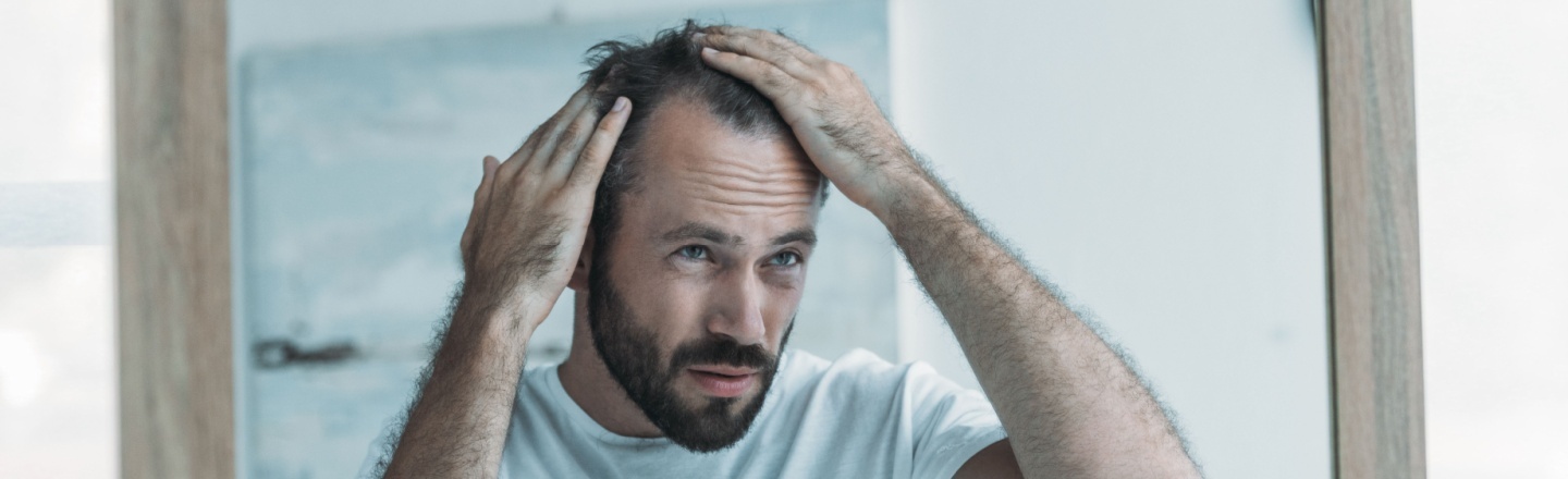 Mitos de la alopecia