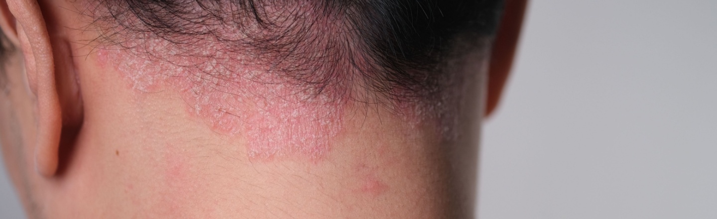 dermatitis seborreica