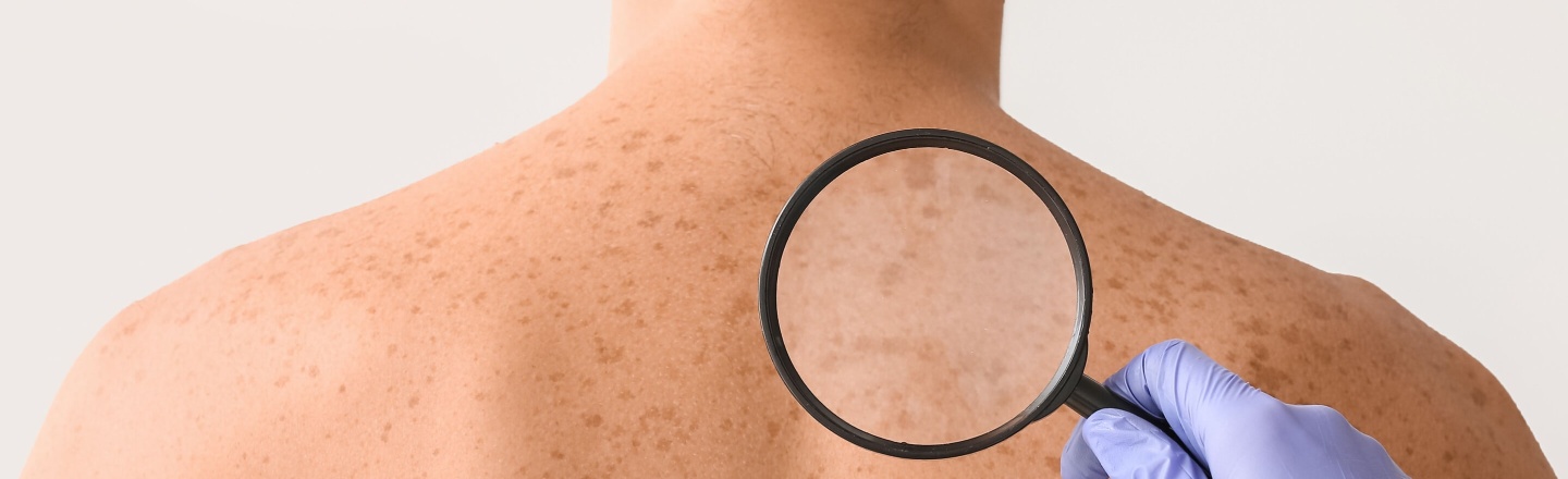 Cómo prevenir el melanoma