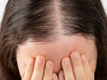 199.-grados-de-alopecia-androgenetica