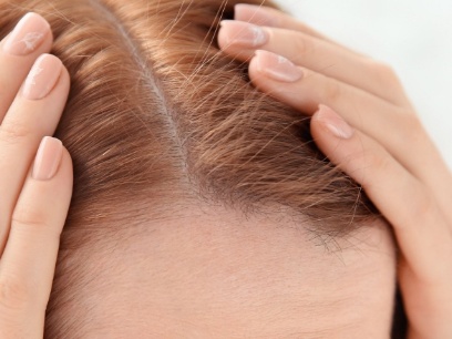 Caída de pelo hormonal