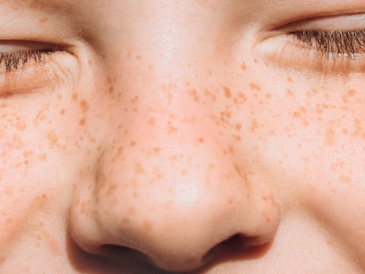 pecas en niños