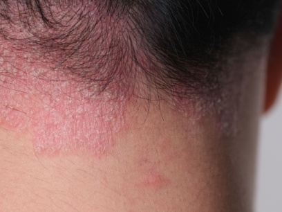 dermatitis seborreica