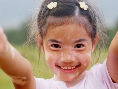 172.-vitiligo-causas-tratamientos