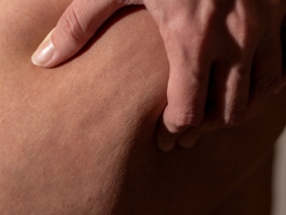 qué es la celulitis
