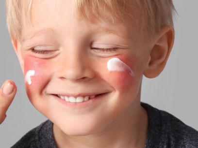 35.-que-causa-el-rubor-facial