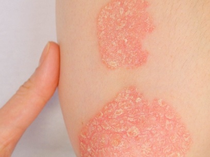 358.-dermatitis-atopica-dermatologa-paloma-borregon