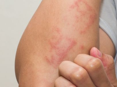 368.-dermatitis-atopica-dermatologa-paloma-borregon