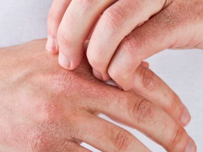 436.-dermatitis-atopica-y-fotoproteccion-dr-pedro-herranz