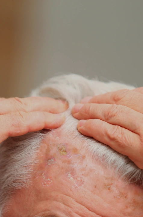 queratosis
