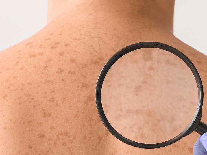 Cómo prevenir el melanoma