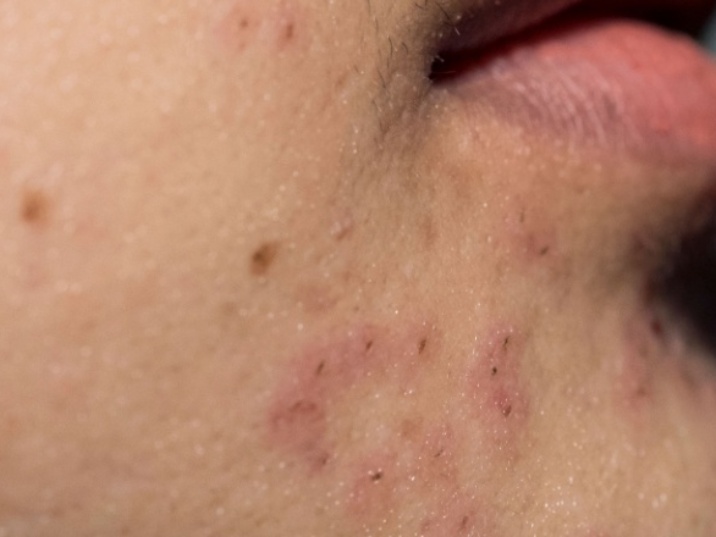 494.-acne