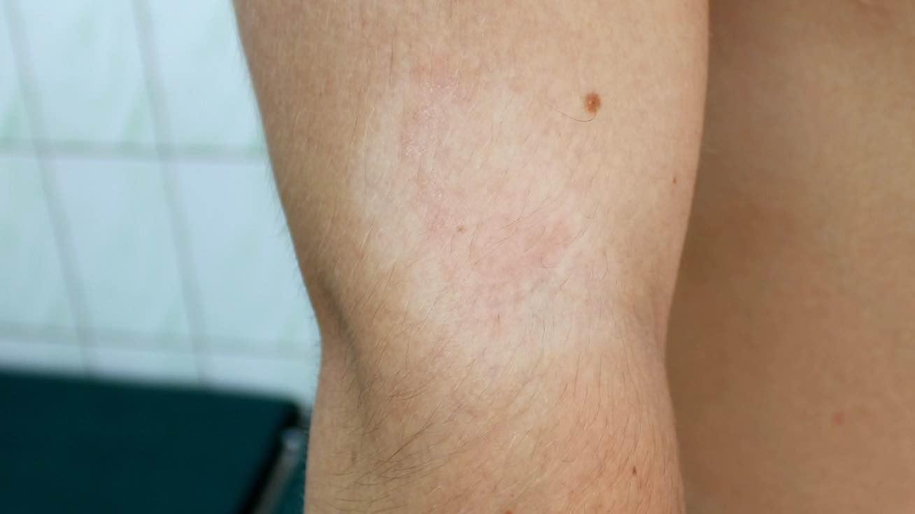pitiriasis-alba-1308x735