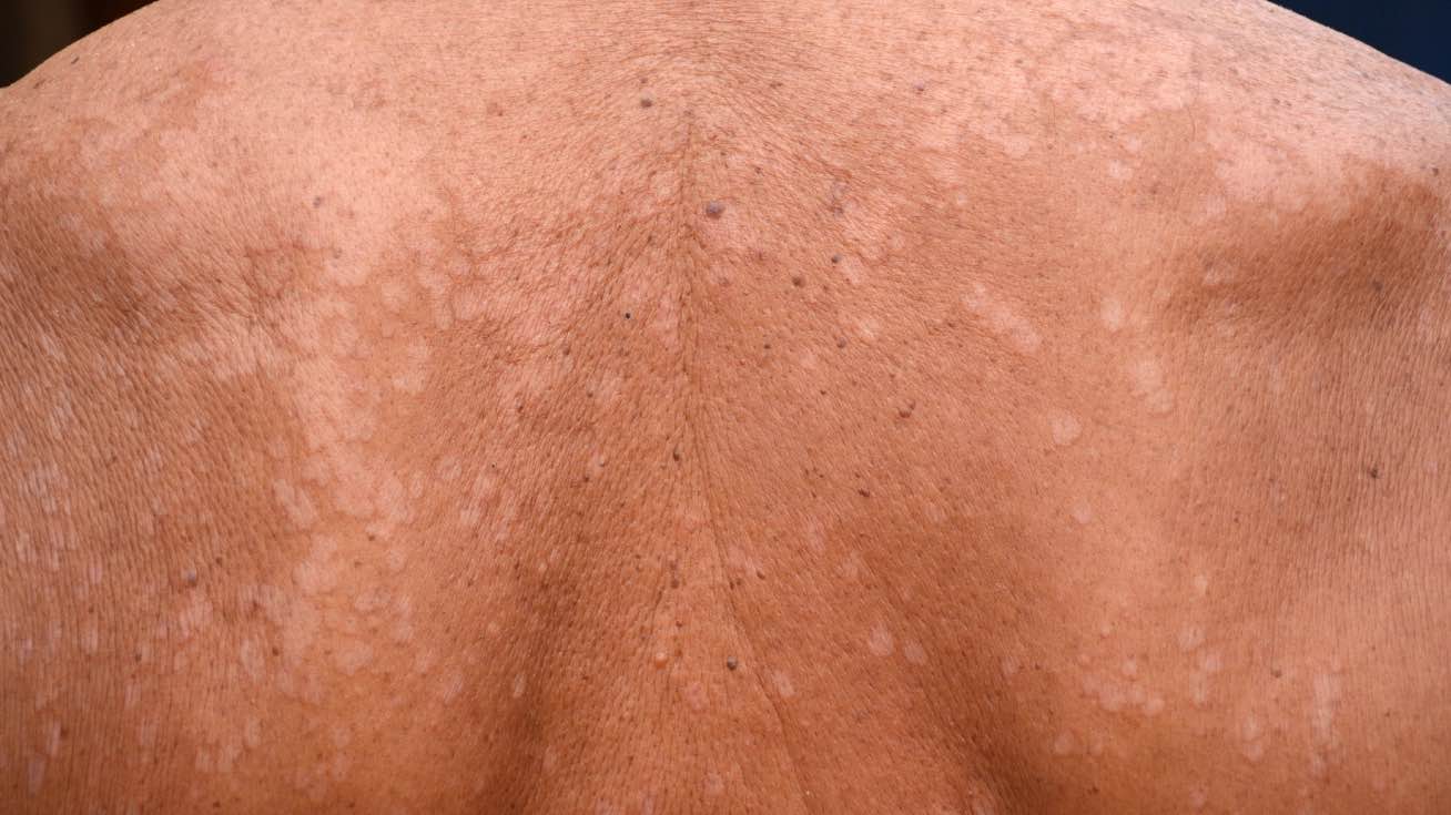 pitiriasis-versicolor-1308x735