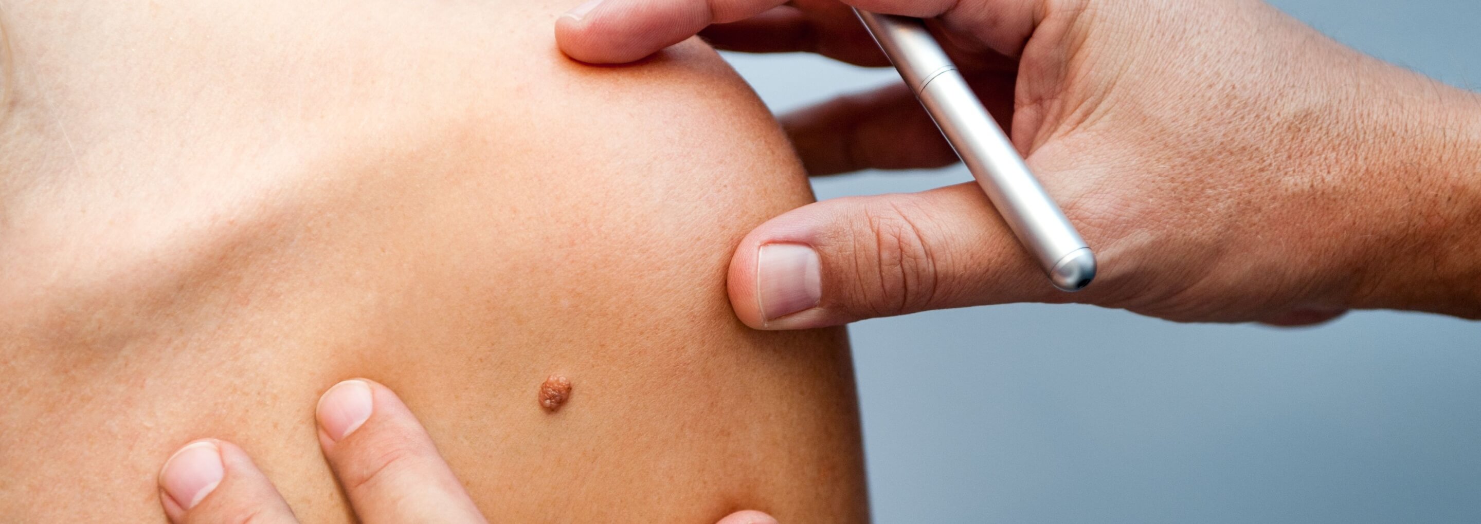 Tratamiento del melanoma