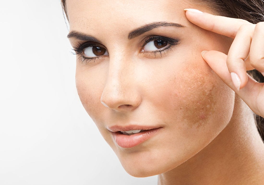 melasma