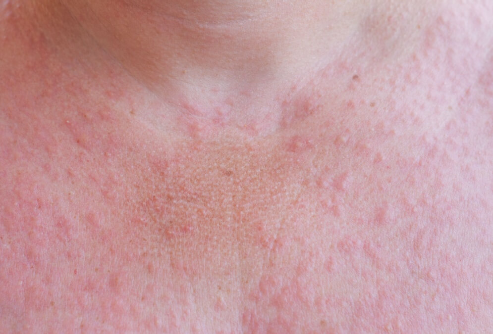 Síntomas del melanoma