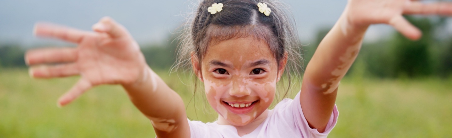 172.-vitiligo-causas-tratamientos