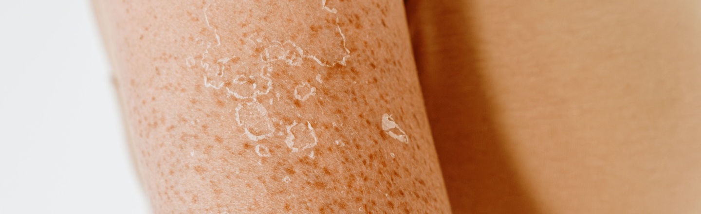 queratosis actínica