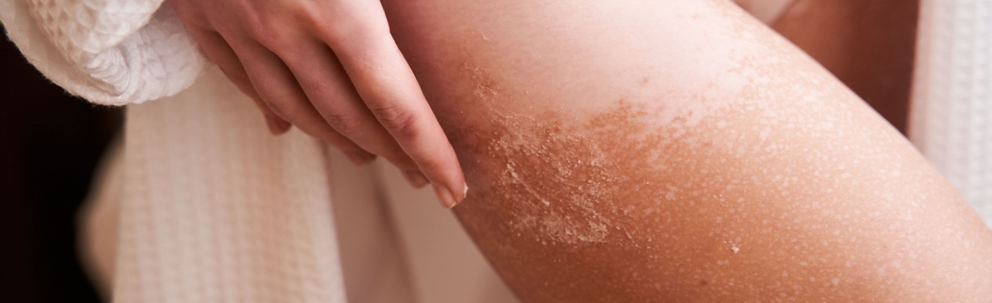tratar queratosis actínica
